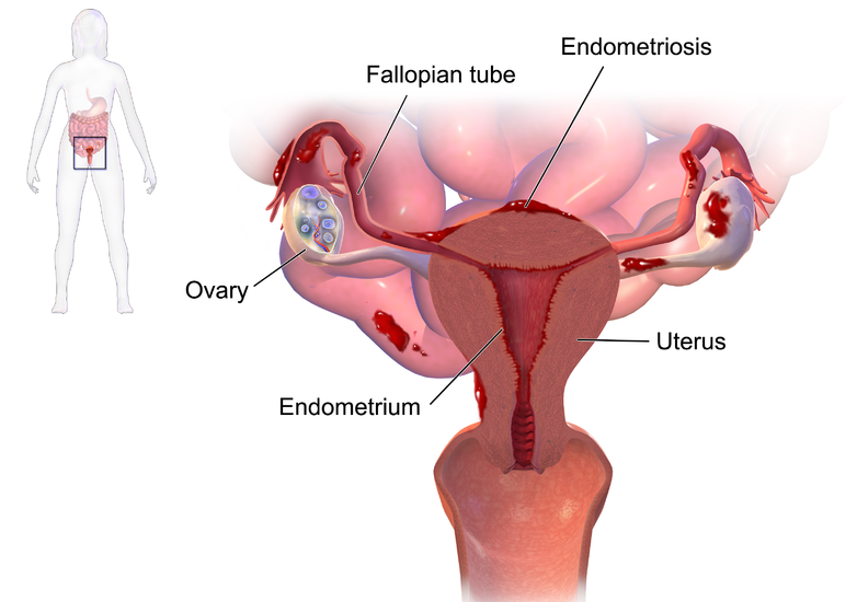 Endometriosis diagram